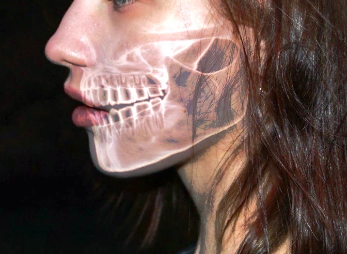 Bone Grafting